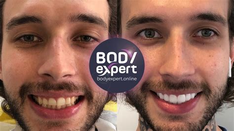 #Turkey Teeth: The Real Story Behind Dental Procedures in Turkey