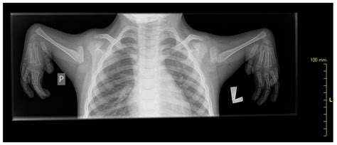 Gait Analysis with an Upper Limb Prosthesis in a Child with ...