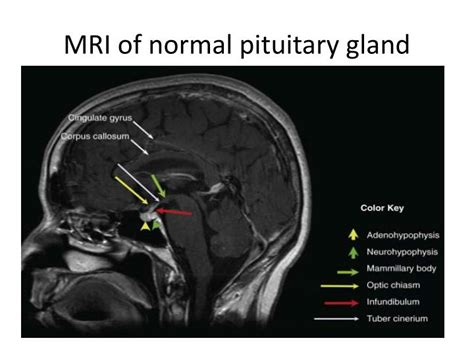 https://image1.slideserve.com/2152992/mri-of-normal-pituitary-gland-n.jpg