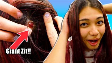 Image result for Loud Exploding Zit