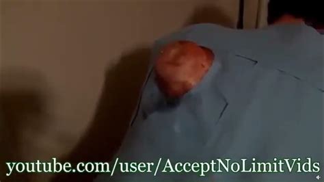 Image result for Cyst Extraction Videos