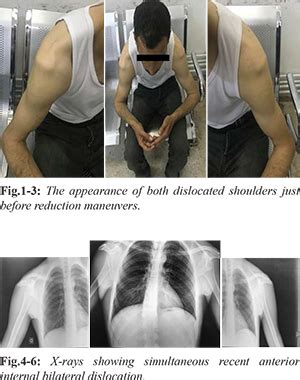 Bilateral Anterior Glenohumeral Dislocation after Epileptic Seizure