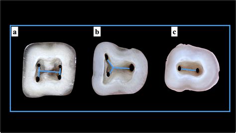 The morphology of the pulp chamber floor of permanent mandibular first ...