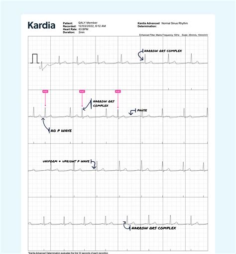 Premature Junctional Contraction (PJC) Vs. Premature Atrial Contraction ...
