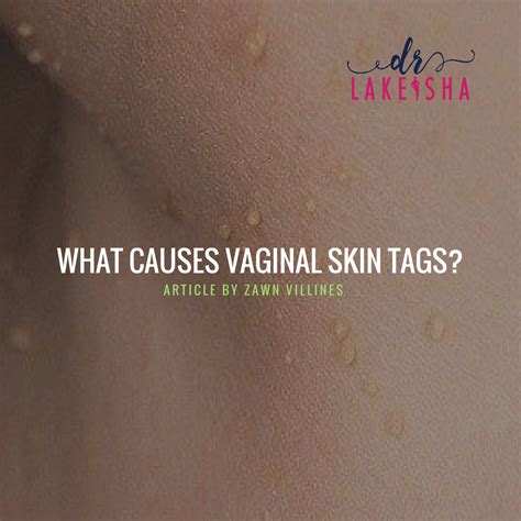 Vaginal Skin Tag