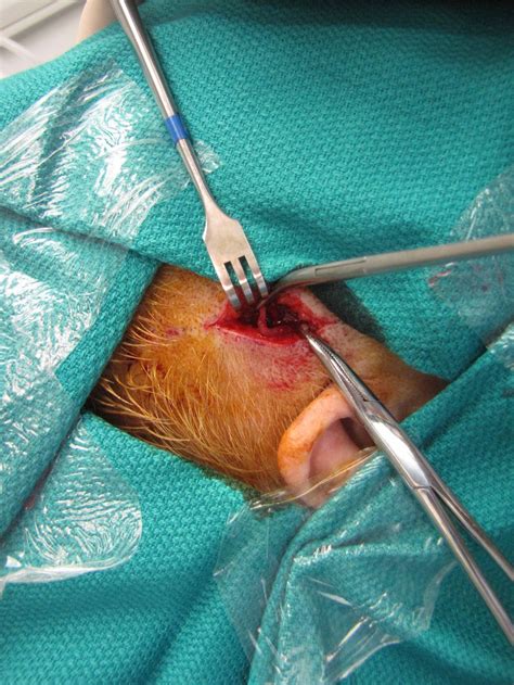 Temporal Arteritis (Giant Cell Arteritis) and Temporal Artery Biopsy ...