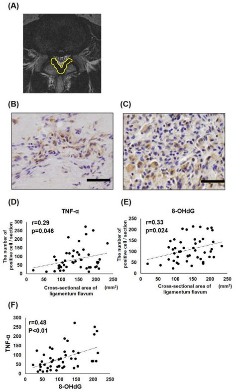 Potential Involvement of Oxidative Stress in Ligamentum Flavum Hypertrophy