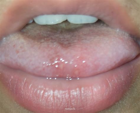 Ask a Internal Medicine Online for Painful Tip Of Tongue