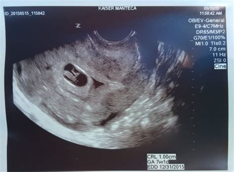 Hidden twin? | BabyCenter
