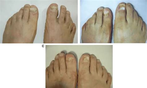 Crisaborole Boosts Effectiveness of Amorolfine in Keratinized Tinea ...
