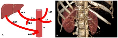 Common Hepatic Artery Model