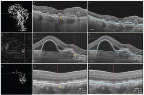 Different Morphology of Branching Neovascular Network in Polypoidal ...