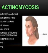Image result for Actinomycosis