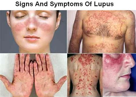 Lupus - Systemic Lupus Erythematosus (SLE) - Causes, Sign & Symptoms