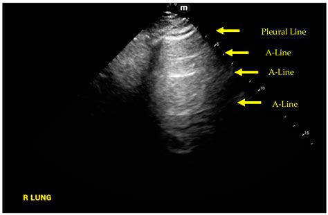 Objective Methods of Assessing Fluid Status to Optimize Volume Management in Kidney Disease and ...