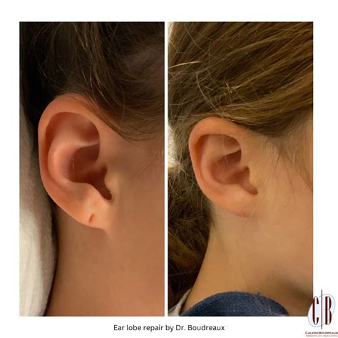 Earlobe Repair | Calkin & Boudreaux Dermatology Associates