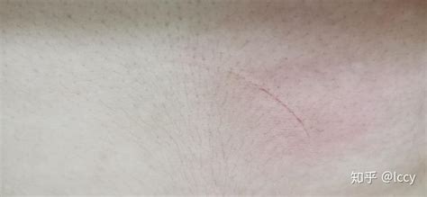 被家里的猫抓伤了，轻微破皮，有一点渗血，需要打针吗 - 知乎