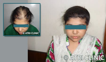 Hair Transplant in Kolkata | Best Hair Clinic - ATRI Clinic