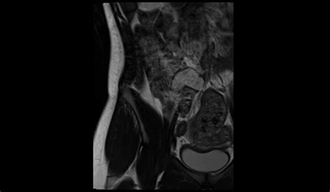 Image result for Normal Appendix MRI