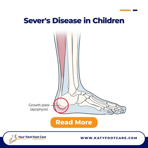 Severs Disease