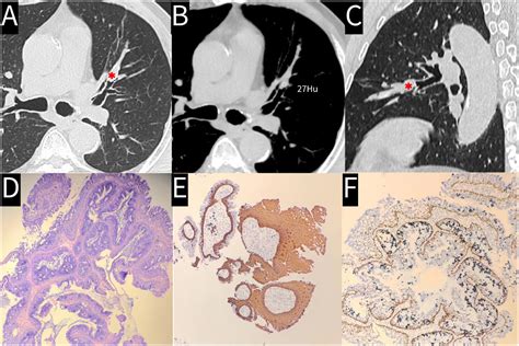 Mixed squamous cell and glandular papilloma of the bronchus | Pulmonology
