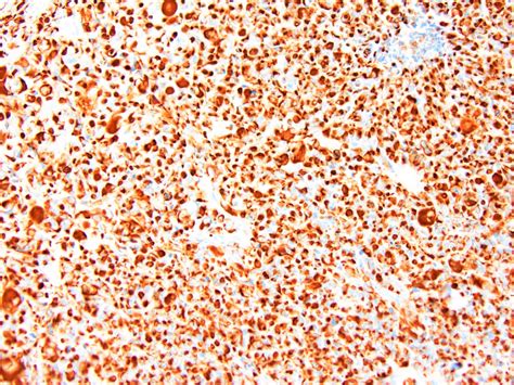 Pathology Outlines - Desmoplastic small round cell tumor