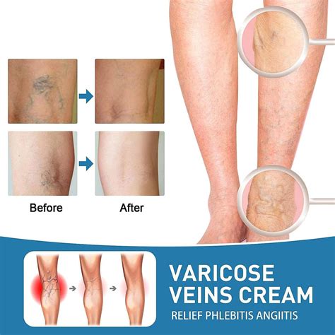 NYYQYYN Varicose Veins Treatment for Legs,Varicose Veins India | Ubuy