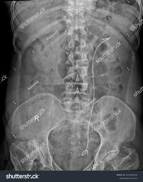 Kub Abdominal X Ray