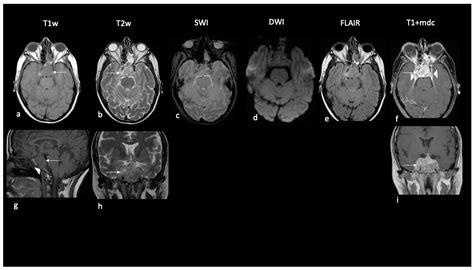Atypical Teratoid Rhabdoid Tumor: Proposal of a Diagnostic Pathway Based on Clinical Features ...
