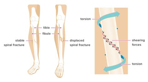 Spiral Fracture: Healing Time, Tibia, and Fibula