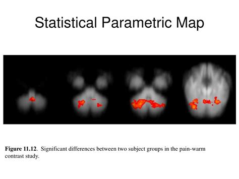 Statistical Parametric Mapping 的图像结果