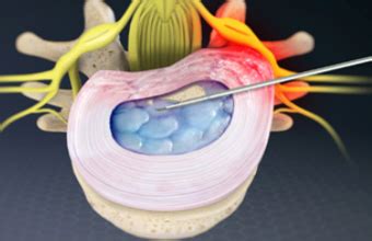 Percutaneous Transforaminal Endoscopic Microdiscectomy...
