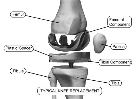 Illustration of Typical Knee Replacement, Hardware Components Re – Hip ...