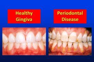 Prevention Is Key: Prioritizing Oral Health