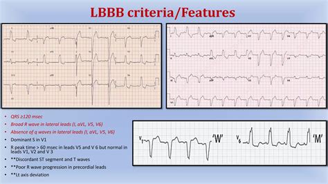 Left Bundle Branch Block (LBBB) | PPTX
