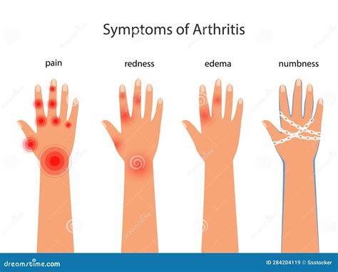 Rheumatoid Arthritis Edema at Zane Bussell blog