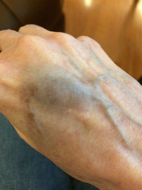 Broken Blood Vessel In Hand - Blogs & Forums