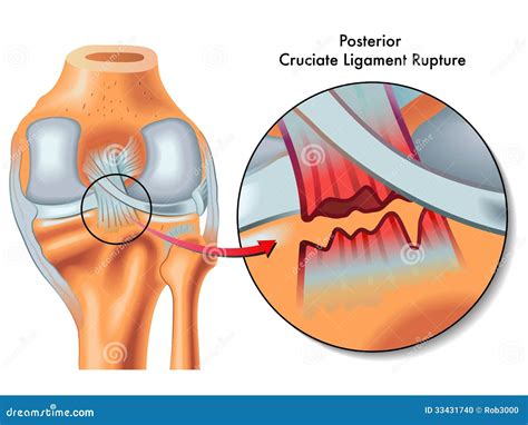 Posterior Cruciate Ligament Rupture Stock Vector - Illustration of anterolateral, cruciate: 33431740