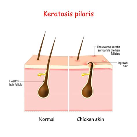 Keratosis pilaris (pureća koža): Može biti vrlo frustrirajuća! Evo što je uzrokuje, kako si ...