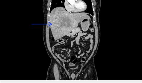 Image result for CT Scan with Contrast