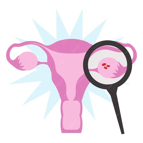 Premium Vector | Uterus ovaries pcos magnifying glass in flat illustration