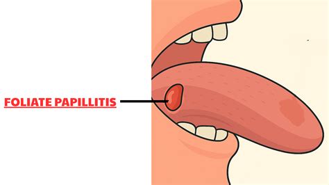 Pimple on Side of Tongue: When to Worry (and When Not To)