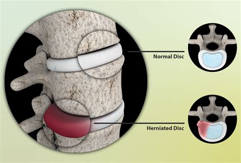 When Is Surgery Needed for a Lumbar Herniated Disc? » Scary Symptoms