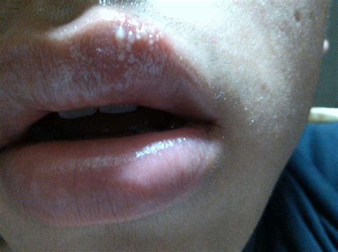 嘴巴周围长痘的原因（这些都是常见原因）