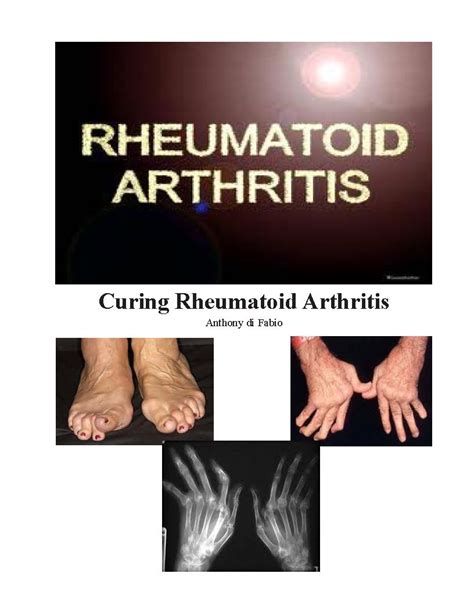Curing Rheumatoid Arthritis eBook : di Fabio, Anthony: Amazon.in ...