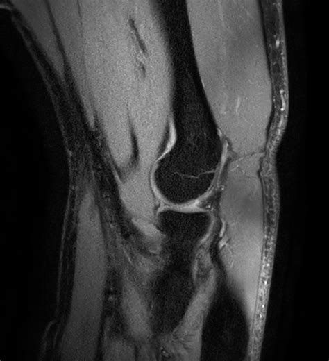 Fat-free elbow imaging | Philips MR Body Map