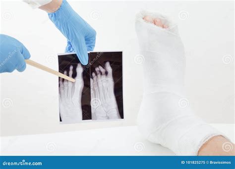 X-ray Image Of Broken Leg, Show Tibia And Fibula Fractures. Royalty-Free Stock Photo ...