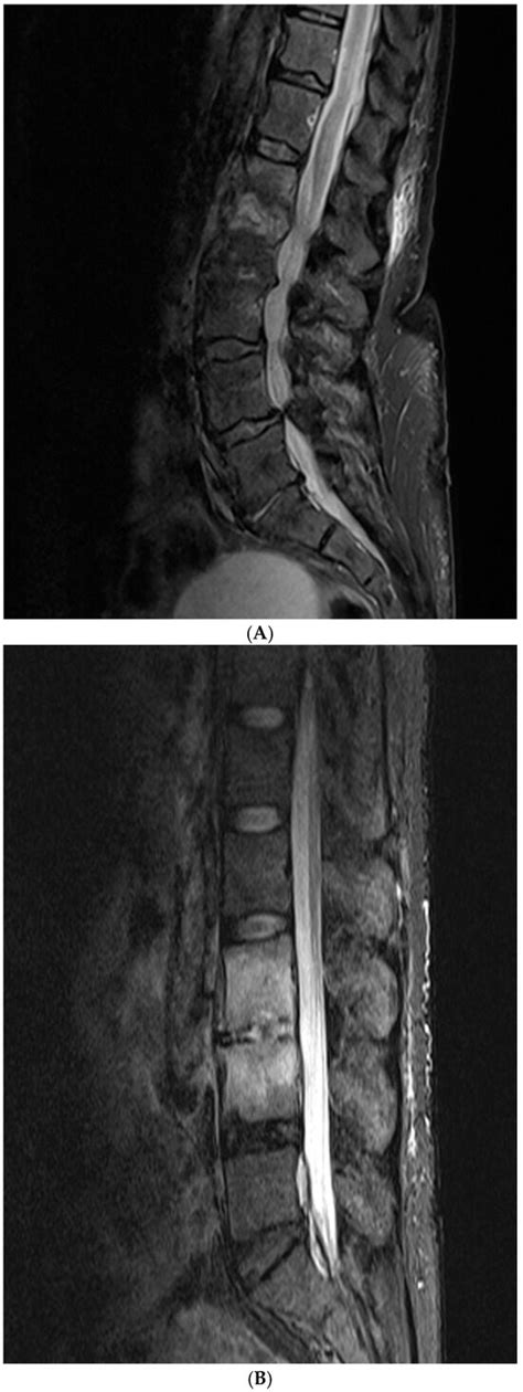 Diagnostic Accuracy of Pre-Biopsy MRI and CT Features for Predicting ...