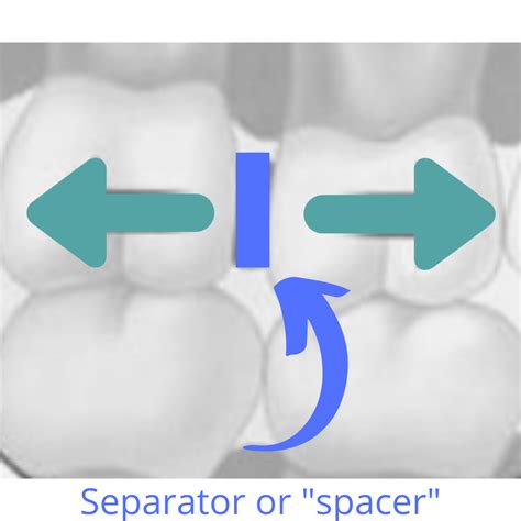 What are orthodontic tooth separators or spacers?