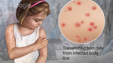 Epidemic Typhus